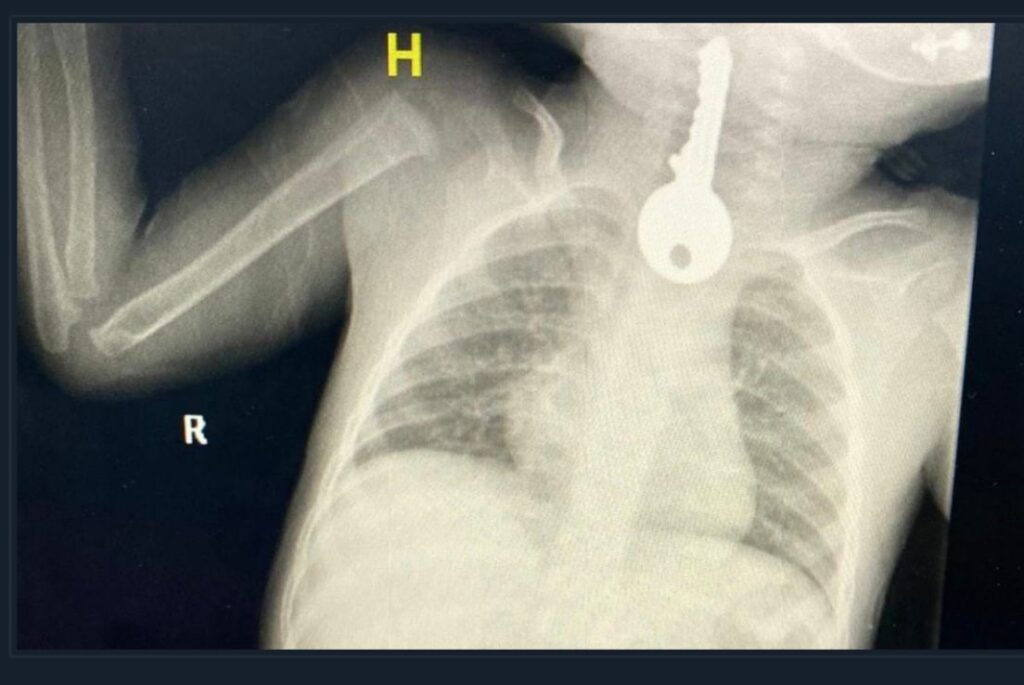 انقاذ طفل ابتلع مفتاح