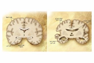رسم توضيحي يقارن بين دماغ سليم ودماغ مصاب بألزهايمر